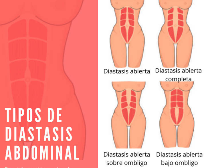 Diástasis abdominal