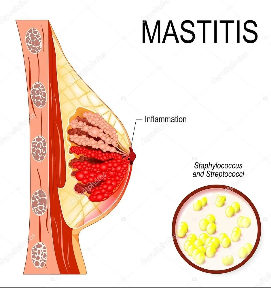 mastitis