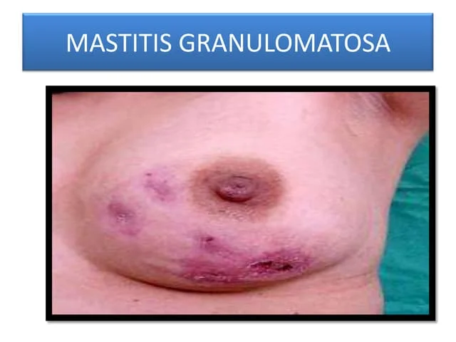 Mastitis granulomatos