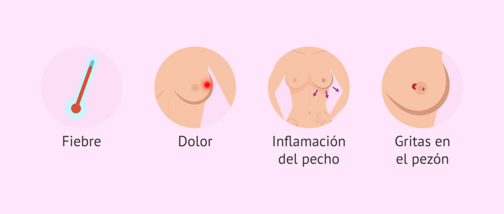 Síntomas de mastitis sin lactancia