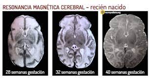 Complicaciones Neurológicas