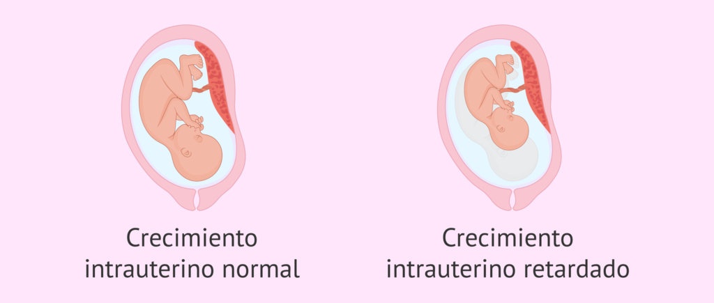 Crecimiento uterino inadecuado