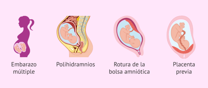 Definición y Causas del Parto Prematuro