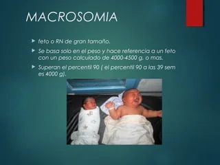 Macrosomía fetal