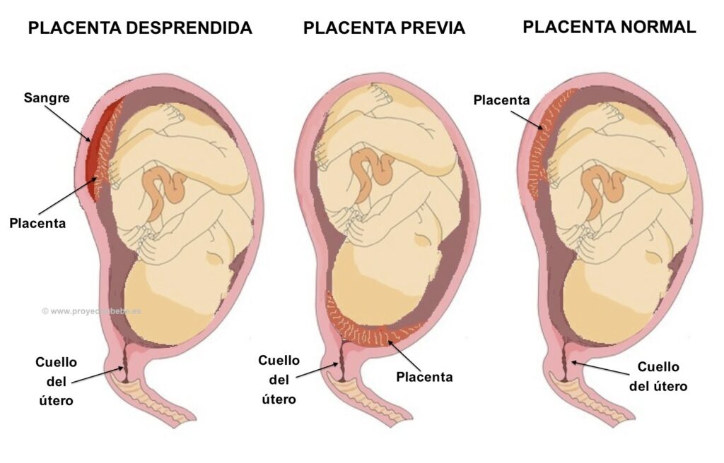 Problemas con la placenta